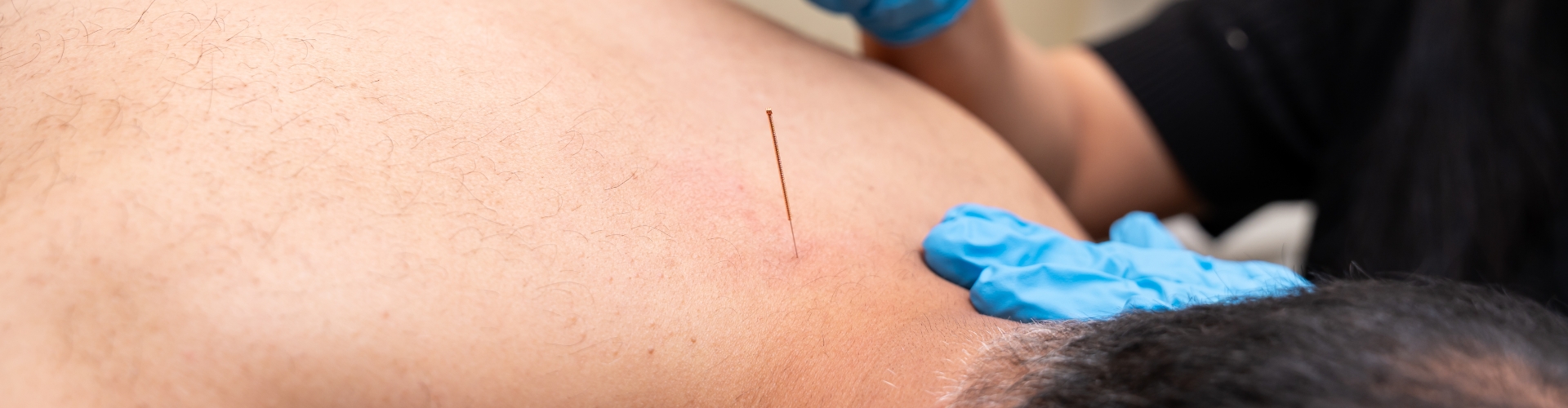 Acupuncture