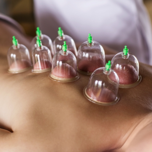 cupping-Haney-Physiotherapy-Maple-Ridge-BC