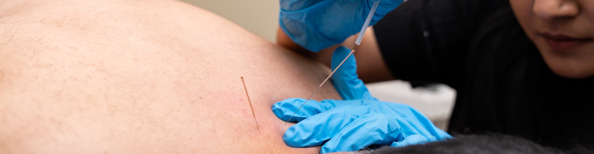 Dry Needling