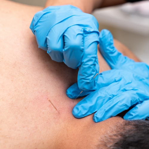 dry-needling-Haney-Physiotherapy-Maple-Ridge-BC